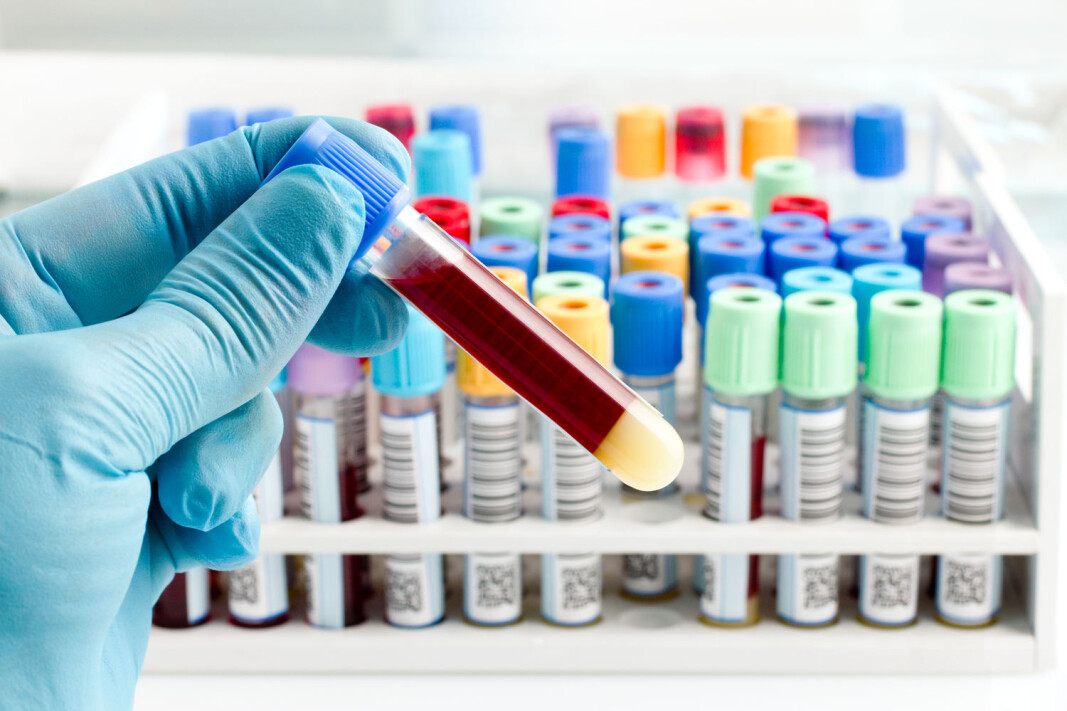One of NIPT’s advantages is that chromosome abnormalities can be detected in the foetus without requiring the more invasive amniocentesis procedure. Pregnant women will still need to undergo amniocentesis to avoid unnecessary abortions if the new blood test indicates a genetic abnormality, according to a consultant. One of NIPT’s advantages is that chromosome abnormalities can be detected in the foetus without requiring the more invasive amniocentesis procedure. Pregnant women will still need to undergo amniocentesis to avoid unnecessary abortions if the new blood test indicates a genetic abnormality, according to a consultant.