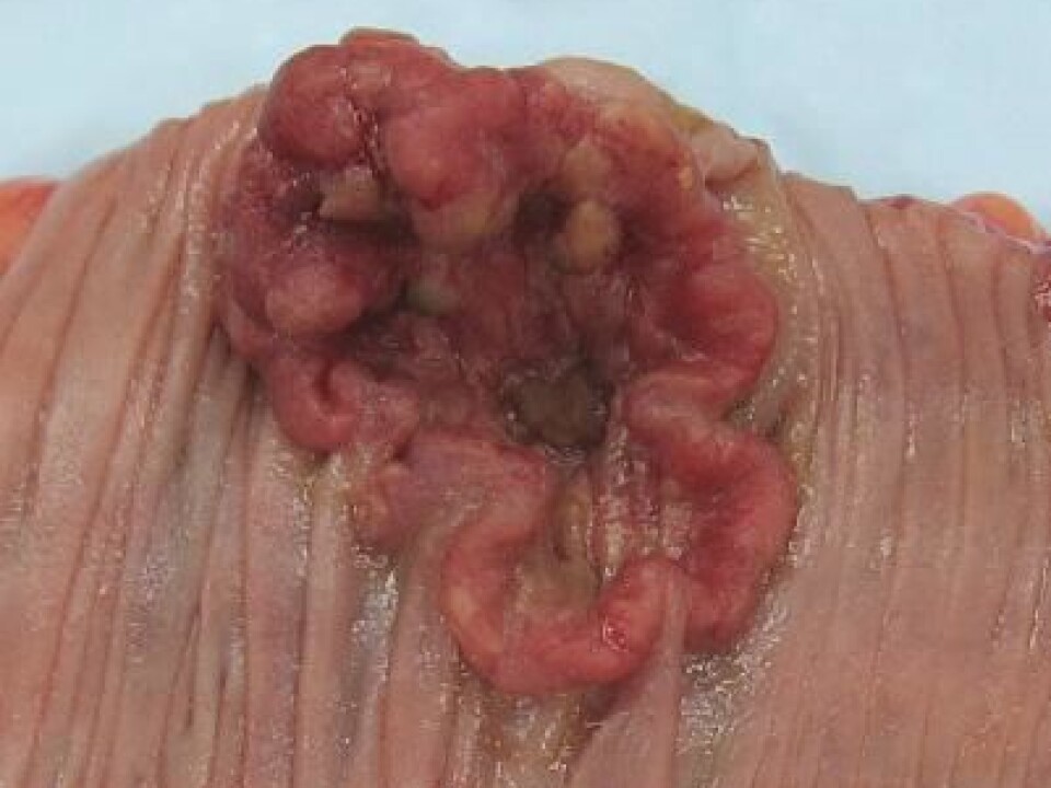 Cancer tumor in colon. (Photo: Emmanuelm, Wikimedia Commons)