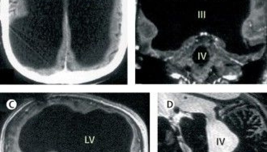 (Photo: from The Lancet article, “Brain of a white-collar worker”) (Photo: from The Lancet article, “Brain of a white-collar worker”)