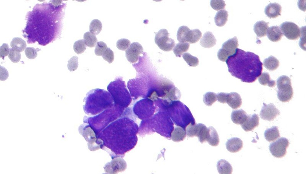Lung cancer cells. The immune system protects us against cancer cells, but there is still very little known about how this immune system protects against cancer. (Photo: Wikipedia Commons) Lung cancer cells. The immune system protects us against cancer cells, but there is still very little known about how this immune system protects against cancer. (Photo: Wikipedia Commons)
