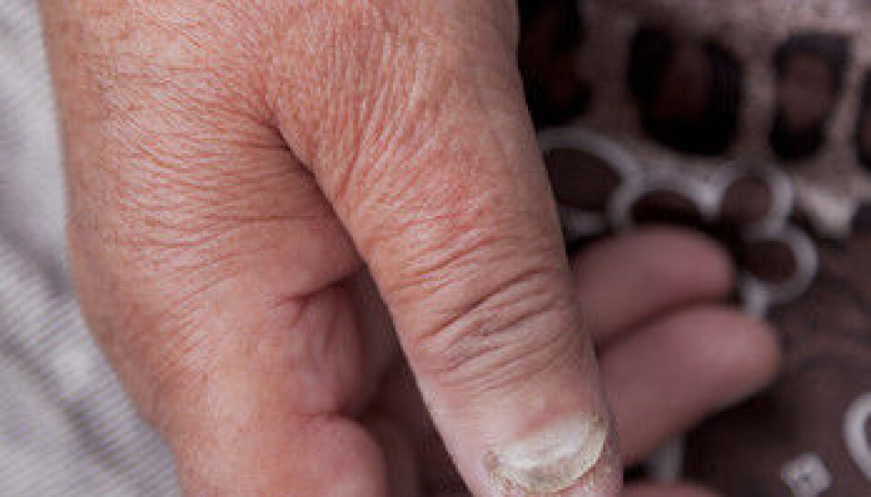 New treatments might be underway for psoriasis and other chronic inflammatory conditions such as rheumatoid arthritis and nephritis. (Illustration photo: Colourbox)