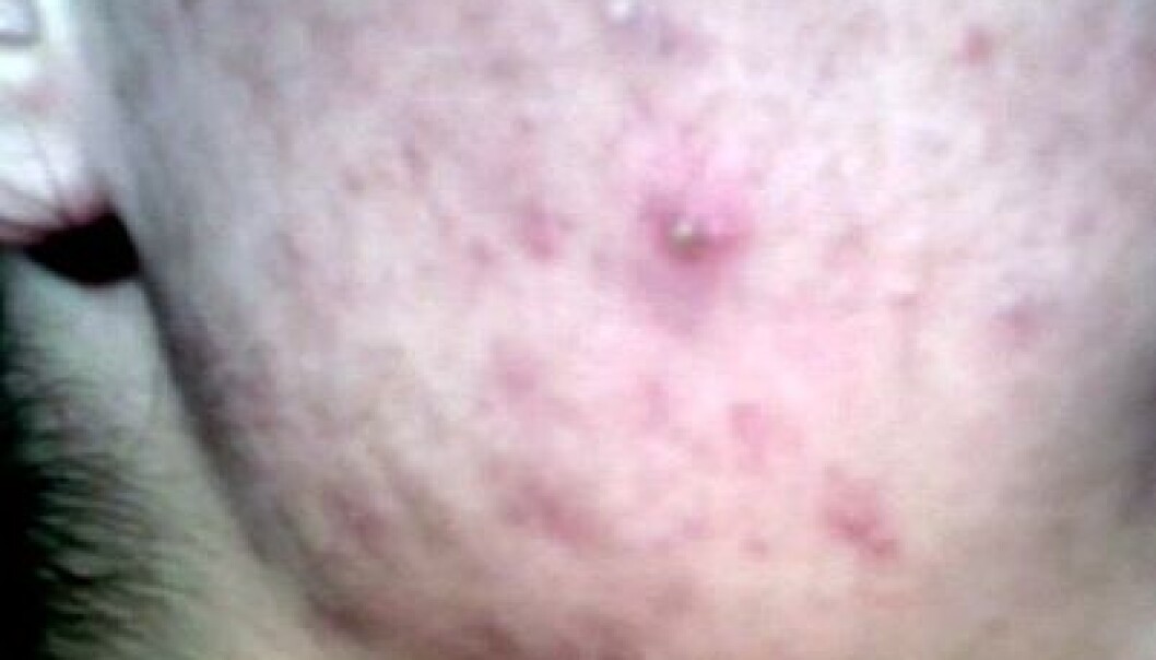 Acne usually crops up at puberty in the ages of 10-12, earlier among girls than boys. (Photo: Wikimedia Commons) Acne usually crops up at puberty in the ages of 10-12, earlier among girls than boys. (Photo: Wikimedia Commons)