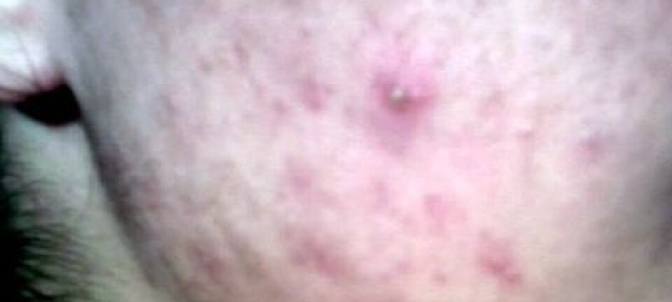 Pimples deserve more respect