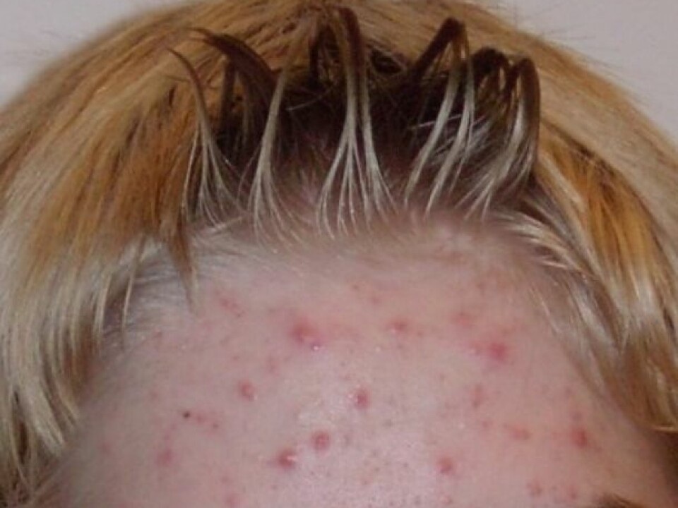 Acne on the forehead of a 14-year-old boy. (Photo: Wikimedia Commons)