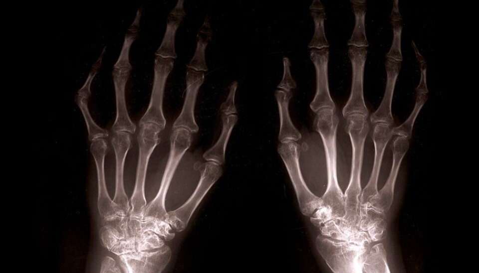 Low bone density can cause weak bones. The wrists in particular can easily fracture. (Illustration photo: Colourbox.com)