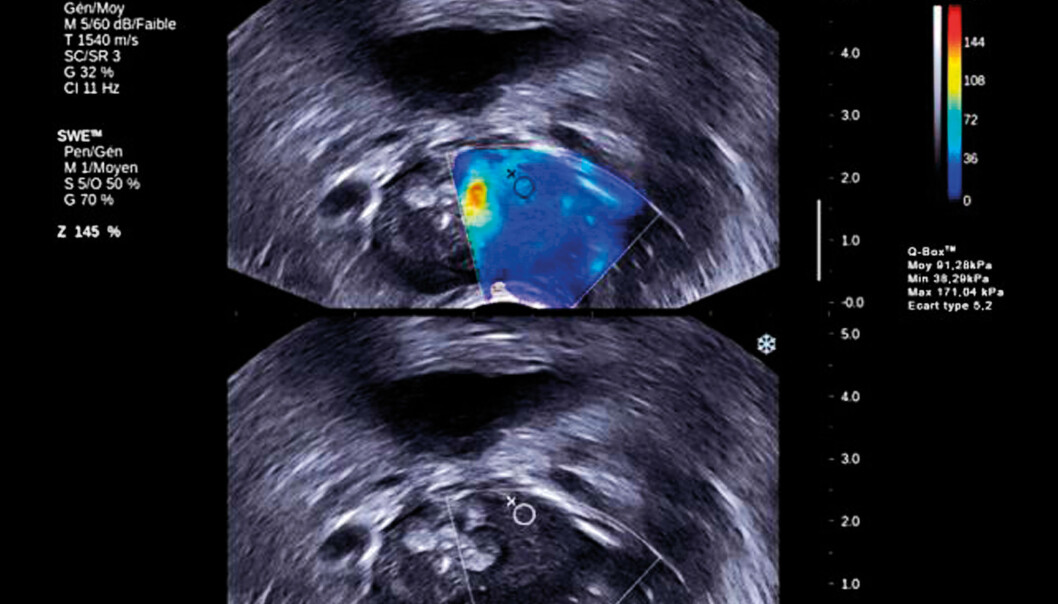 Ultrasound creates two types of waves: pressure waves and shear waves. Current ultrasound examinations measure the pressure waves. The new ultra sound examination measures the shear waves. Until now it has not been possible to measure the shear waves. Shear waves can be used to measure elasticity in soft tissue. (Photo: Supersonic Imagine) Ultrasound creates two types of waves: pressure waves and shear waves. Current ultrasound examinations measure the pressure waves. The new ultra sound examination measures the shear waves. Until now it has not been possible to measure the shear waves. Shear waves can be used to measure elasticity in soft tissue. (Photo: Supersonic Imagine)
