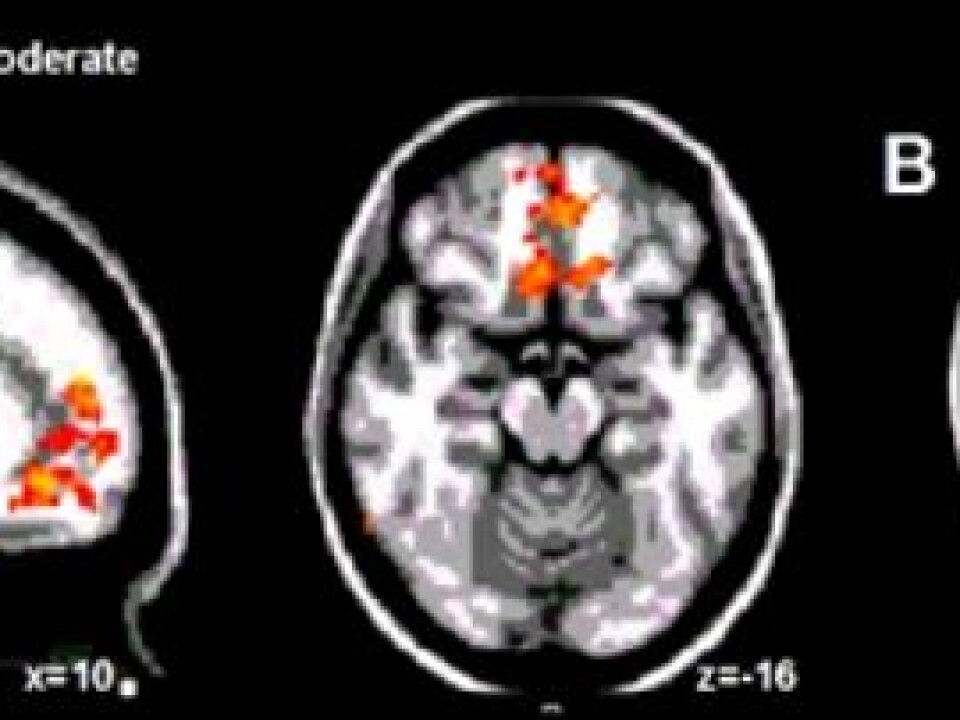 When a sense of relief turned pain into pleasure, researchers found activity in the middle of the frontal lobes of the brain, areas normally associated with comfort and the relative value of a specific experience (Image A). At the same time, they witnessed a change in activity in the same region of the brain stem that regulates pain, for example, when morphine is administered in medical treatment (Image B).
