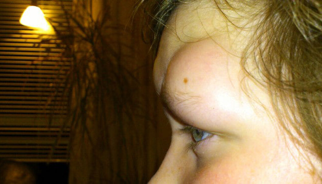 This boy was among the unlucky few in Finnmark County in North Norway to be infected by a warble fly last year. The fly lays its eggs under the skin and developing larvae cause large swellings (warbles), as can be seen on his face. It took some time before the health services reached the right diagnosis. (Private photo) This boy was among the unlucky few in Finnmark County in North Norway to be infected by a warble fly last year. The fly lays its eggs under the skin and developing larvae cause large swellings (warbles), as can be seen on his face. It took some time before the health services reached the right diagnosis. (Private photo)