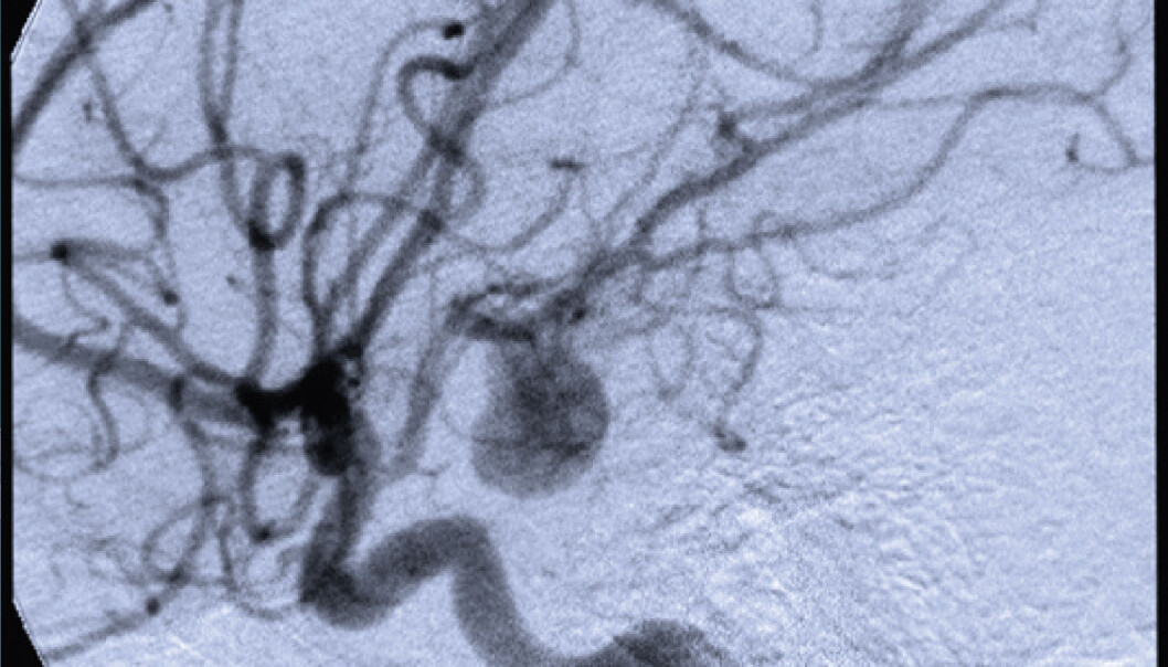 A medical image of the brain with blood vessels and aneurisms. (Photo: CBC/UiO) A medical image of the brain with blood vessels and aneurisms. (Photo: CBC/UiO)