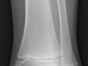 Oestrogen treatment makes the growth plate, the opening between the end and the rest of the bone, to close or fuse sooner. This is a leg bone of a 12-year-old. (Photo: Gilo1969/Wikimedia Creative Commons) Oestrogen treatment makes the growth plate, the opening between the end and the rest of the bone, to close or fuse sooner. This is a leg bone of a 12-year-old. (Photo: Gilo1969/Wikimedia Creative Commons)