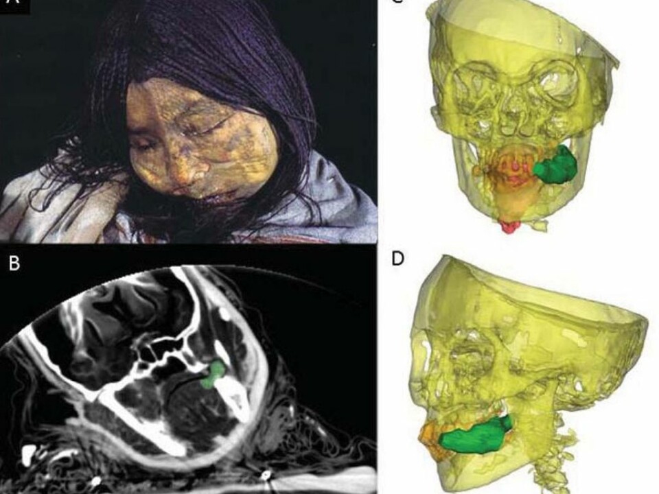 La Donchella’s face in a photo, an x-ray and CT scans. The green object is a wad of coca leaf she was chewing at the time of death. Her tongue is shown in red. (Photo: Johan Reinhard)