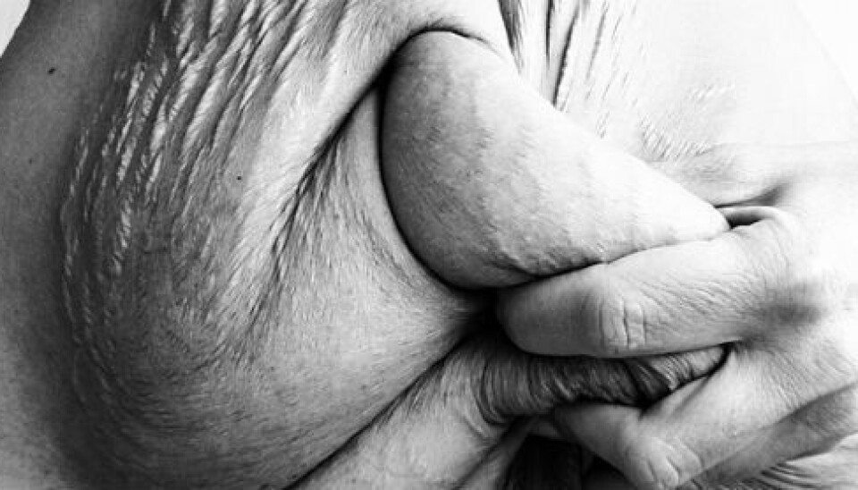 Obesity surgery results in rapid weight loss, but comes at a cost. Skin that has been pulled and stretched for years is left behind – in abundance. (Photo: Tine Dyrkorn)