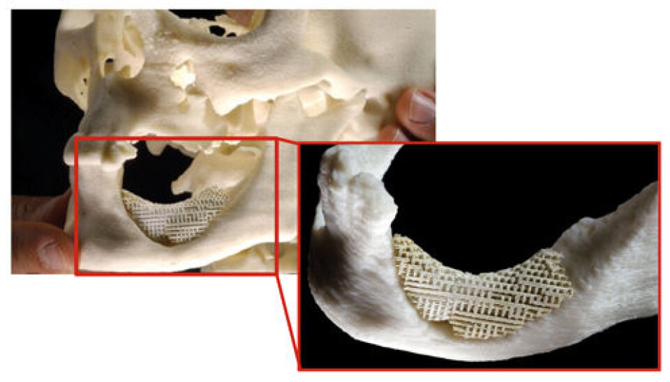 If the mandible (lower jaw) is damaged, an artificial scaffolding made from food additives may be the solution.