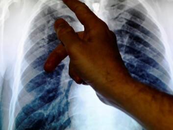 Chest x-rays are called for when pulmonary tuberculosis is suspected. (Photo: Luke Macgregor/Reuters)