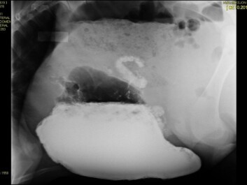 An x-ray showing the stomach of a standing calf while drinking milk mixed with a contrast medium. Here the true stomach, or abomasum, is filled with four litres of milk, which had entered through the so-called oesophageal groove. The picture shows that the abomasum expands to compensate for the milk volume. Nothing flows over to the paunch, as was previously feared. (Photo: Nina Ottesen, NMBU) An x-ray showing the stomach of a standing calf while drinking milk mixed with a contrast medium. Here the true stomach, or abomasum, is filled with four litres of milk, which had entered through the so-called oesophageal groove. The picture shows that the abomasum expands to compensate for the milk volume. Nothing flows over to the paunch, as was previously feared. (Photo: Nina Ottesen, NMBU)