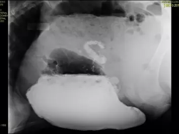 An x-ray showing the stomach of a standing calf while drinking milk mixed with a contrast medium. Here the true stomach, or abomasum, is filled with four litres of milk, which had entered through the so-called oesophageal groove. The picture shows that the abomasum expands to compensate for the milk volume. Nothing flows over to the paunch, as was previously feared. (Photo: Nina Ottesen, NMBU)