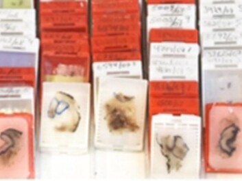 Sliced sections of colon cancer tumours, preserved in wax. (Photo: Jarle Bruun) Sliced sections of colon cancer tumours, preserved in wax. (Photo: Jarle Bruun)