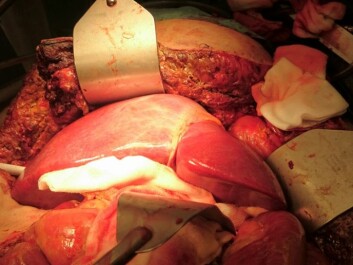 A healthy donor liver is transplanted to a cancer patient. (Photo: Oslo University Hospital)