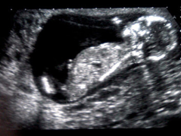 The diseases start in utero. (Photo: Colourbox) The diseases start in utero. (Photo: Colourbox)