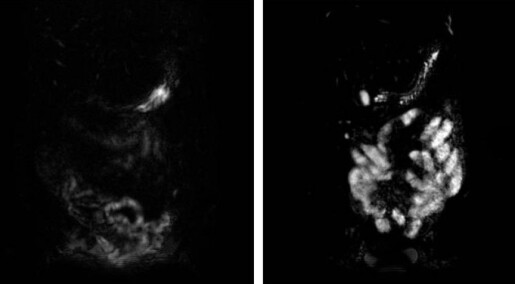First image of an irritable bowel First image of an irritable bowel