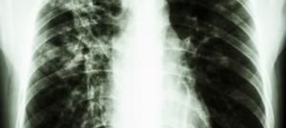 DNA sequencing reveals how tuberculosis epidemic spread