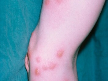 In a new study American scientists conducted on mice, they found that bedbugs can transmit the dreaded parasite Trypanosoma cruzi. (Photo: Science Photo Library/Scanpix) In a new study American scientists conducted on mice, they found that bedbugs can transmit the dreaded parasite Trypanosoma cruzi. (Photo: Science Photo Library/Scanpix)