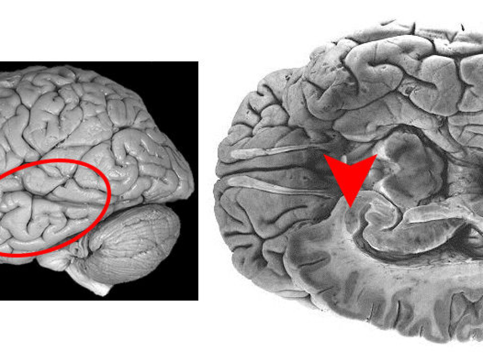 These two pictures show the human brain. The area that is called the amygdala is marked with a circle and arrow. Data from the amygdala is similar to what NTNU researchers have found in the moth’s lateral horn. (Illustration: NTNU)
