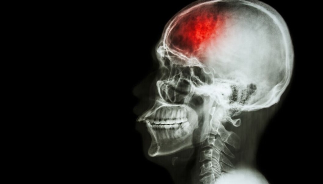 Researchers think that learning more about the FSAP gene can reveal new ways to treat stroke and heart attack. (Photo: Colourbox) Researchers think that learning more about the FSAP gene can reveal new ways to treat stroke and heart attack. (Photo: Colourbox)