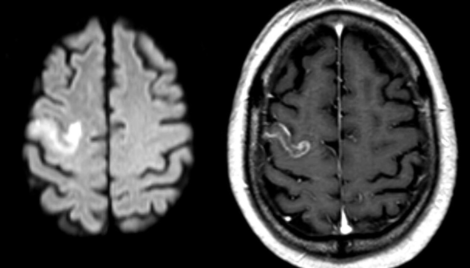 A new method analysis promises better treatment for stroke patients with language problems in the future. (Photo: Wikimedia Commons/Hellerhoff)