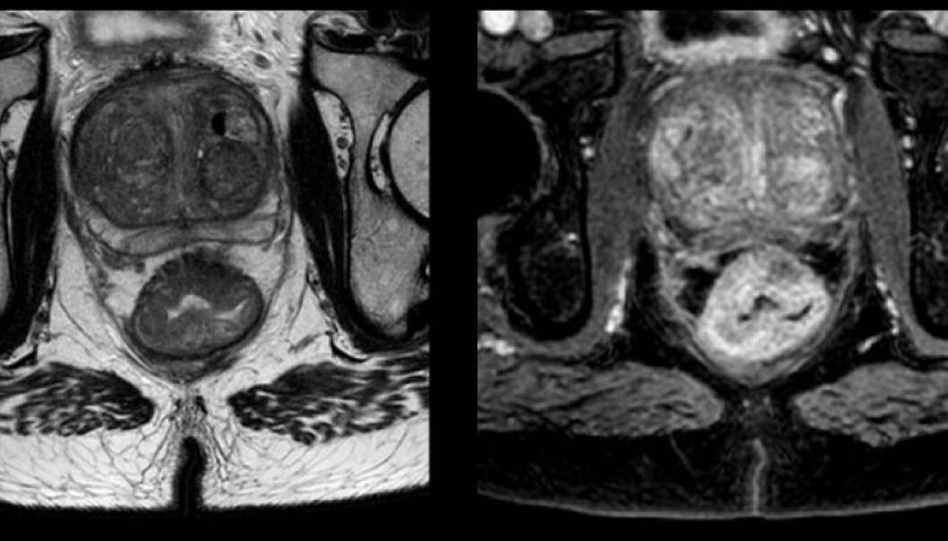 The images above are from a patient in the study with intestinal cancer. At the bottom of the picture we see the two “buns” of the patient’s behind. The rounded shape right above the crack is a rectal cancer tumour. Researchers hope to improve treatment by “peering into” the tumour. (Photo: OxyTarget study) The images above are from a patient in the study with intestinal cancer. At the bottom of the picture we see the two “buns” of the patient’s behind. The rounded shape right above the crack is a rectal cancer tumour. Researchers hope to improve treatment by “peering into” the tumour. (Photo: OxyTarget study)