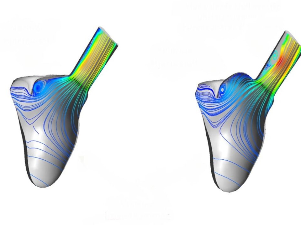 Researchers have carried out studies of both vein and valve placement, and how different valve geometries affect blood flow patterns within the heart. The illustrations demonstrate how changes in valve Researchers have carried out studies of both vein and valve placement, and how different valve geometries affect blood flow patterns within the heart. The illustrations demonstrate how changes in valve geometry alter blood flow as it leaves the heart and enters the aorta. This may be of vital importance when deciding which patients should be operated on, and which surgical procedure should be selected. (Illustration: SINTEF)