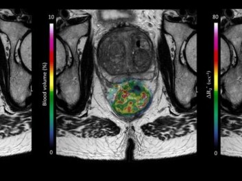 An MRI from a patient in the OxyTarget study who has a large rectal tumour. The picture also shows how the computer model can peek into the tumour, revealing through colours how blood and nutrients flow into the tumour. The work on the model was done by Endre Grøvik and Kathrine Røe Redalen. (Image: OxyTarget (NCT01816607)) An MRI from a patient in the OxyTarget study who has a large rectal tumour. The picture also shows how the computer model can peek into the tumour, revealing through colours how blood and nutrients flow into the tumour. The work on the model was done by Endre Grøvik and Kathrine Røe Redalen. (Image: OxyTarget (NCT01816607))