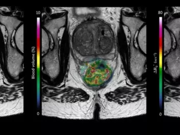 An MRI from a patient in the OxyTarget study who has a large rectal tumour. The picture also shows how the computer model can peek into the tumour, revealing through colours how blood and nutrients flow into the tumour. The work on the model was done by Endre Grøvik and Kathrine Røe Redalen. (Image: OxyTarget (NCT01816607))