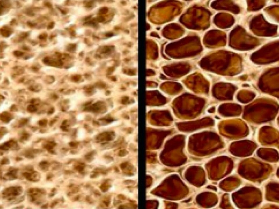 Normal bone tissue on the left and bone with osteoporosis. (Photo: CCM Melbourne)