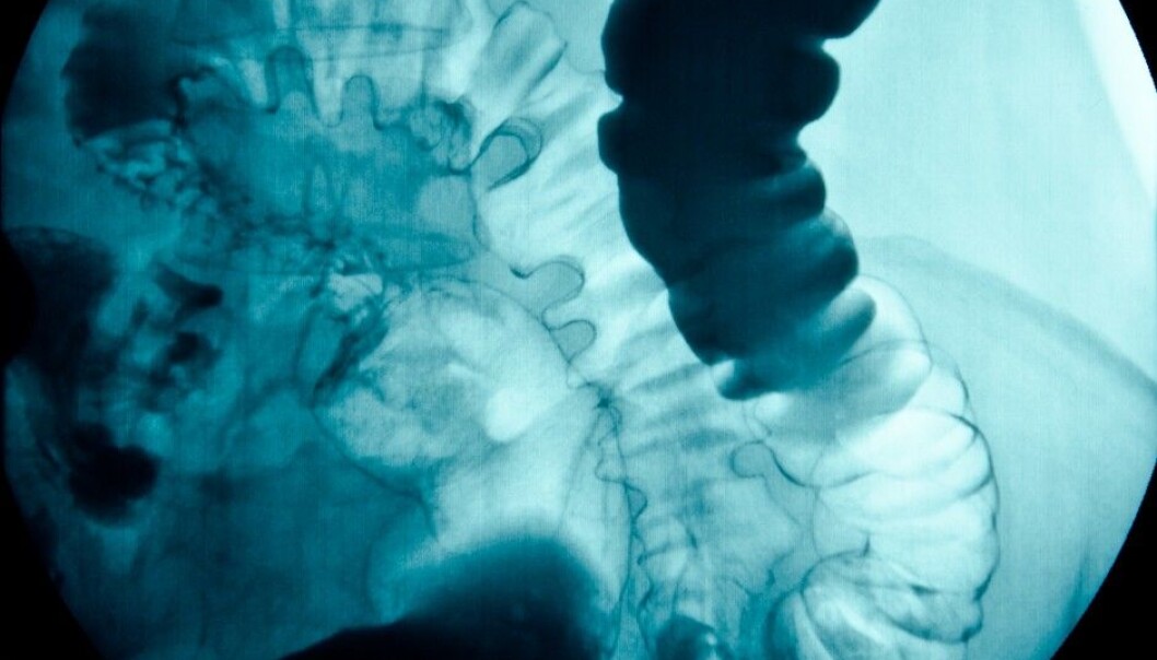 Early diagnosis is important in colorectal cancer. Norway is only average in terms of decreases in mortality from the disease over the last 40 years. The picture shows an X-ray of a stomach. (Photo: Microstock) Early diagnosis is important in colorectal cancer. Norway is only average in terms of decreases in mortality from the disease over the last 40 years. The picture shows an X-ray of a stomach. (Photo: Microstock)