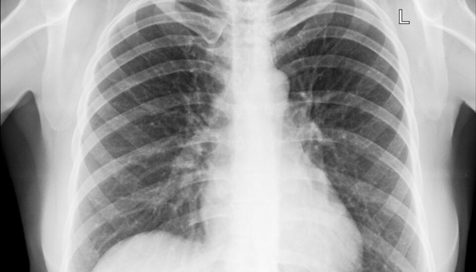 Cecilie Svanes has found that the aging of the lungs is influenced by factors early in life, such as the time you were born.(Illustrative photo: Colourbox.)