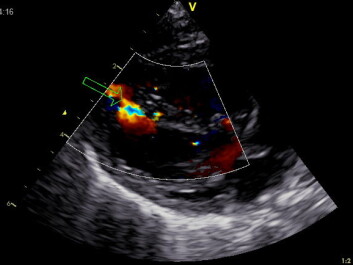 This ultrasound image reveals a small hole in the septum, in this case considered harmless. (Photo: Jarle Jortveit) This ultrasound image reveals a small hole in the septum, in this case considered harmless. (Photo: Jarle Jortveit)