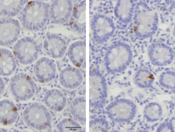The picture shows an intestinal sample from a healthy person (left), which has more endocrine cells than the sample of an IBS patient. (Photo: Magdy El-Salhy / World Journal of Gastroenterology) The picture shows an intestinal sample from a healthy person (left), which has more endocrine cells than the sample of an IBS patient. (Photo: Magdy El-Salhy / World Journal of Gastroenterology)