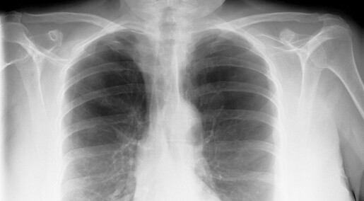 Can vitamin D help against COPD? Can vitamin D help against COPD?