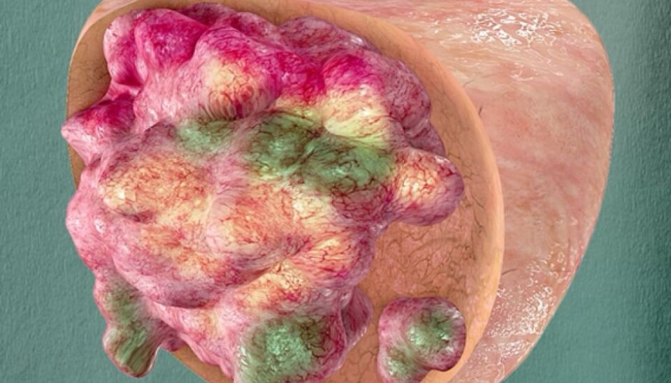 When a doctor takes a tissue sample from a tumor in order to diagnose cancer, they only take out a very small part. However, this can give a false picture of how serious the state of the patient really is. This is because a tumor consists of a range of different cancer cells. This image shows the degree of variations in a prostate tumor. (Illustration: Oslo University Hospital)