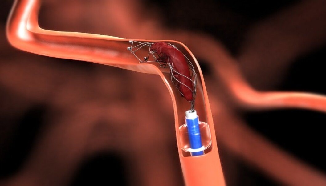 More Norwegian stroke victims can now be treated by having blood clots “fished” out of the brain. This procedure, called mechanical thrombectomy, provides better quality of life afterwards than the standard drug treatment. (Photo: Solitaire – equipment manufacturer) More Norwegian stroke victims can now be treated by having blood clots “fished” out of the brain. This procedure, called mechanical thrombectomy, provides better quality of life afterwards than the standard drug treatment. (Photo: Solitaire – equipment manufacturer)