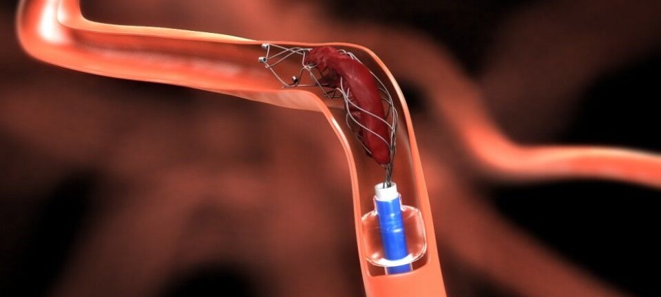 Fishing for blood clots will help more stroke victims