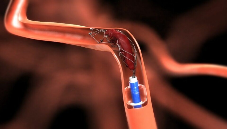 More Norwegian stroke victims can now be treated by having blood clots “fished” out of the brain. This procedure, called mechanical thrombectomy, provides better quality of life afterwards than the standard drug treatment. (Photo: Solitaire – equipment manufacturer)