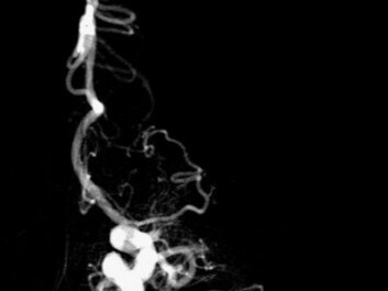 Picture of a blood clot before being fished out. (Photo: UiB) Picture of a blood clot before being fished out. (Photo: UiB)