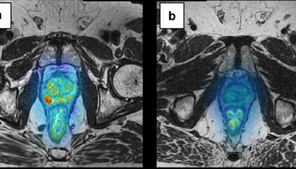 The photo shows malignant prostate tumours prior to treatment (left) and after treatment (right) using a vaccine that stimulated the patient’s immune defence. The red areas highlight the cancer tumours and visibly this patient has benefited from the treatment. (Photo: Wolfgang Lilleby/Cancer Immunology, Immunotherapy)