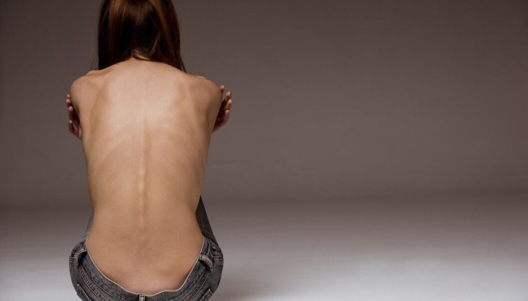 “If anorexia is recognized as both a mental and a metabolic disease, it may encourage drug companies to try to develop medications for treatment, “If anorexia is recognized as both a mental and a metabolic disease, it may encourage drug companies to try to develop medications for treatment,