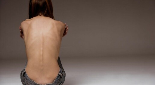 Genetics may explain susceptibility to anorexia