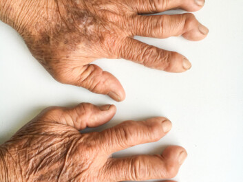 Arthritis can deform both fingers and toes and make it harder to move. (Photo: Shutterstock / NTB scanpix) Arthritis can deform both fingers and toes and make it harder to move. (Photo: Shutterstock / NTB scanpix)