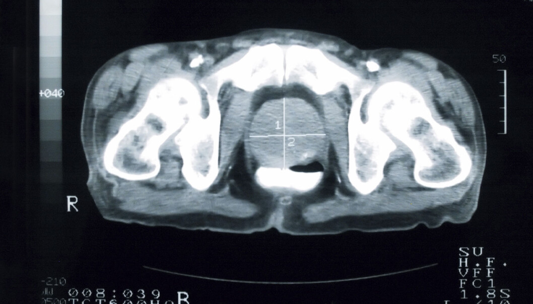 When a cancer has made the prostate as large as seen here, three times normal (in middle with white cross), it’s probably crucial for it to be treated. But how can life-threatening cancers be distinguished from more benign types in early stages? (Photo: Istockphoto) When a cancer has made the prostate as large as seen here, three times normal (in middle with white cross), it’s probably crucial for it to be treated. But how can life-threatening cancers be distinguished from more benign types in early stages? (Photo: Istockphoto)