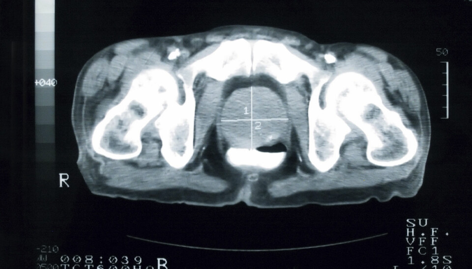 When a cancer has made the prostate as large as seen here, three times normal (in middle with white cross), it’s probably crucial for it to be treated. But how can life-threatening cancers be distinguished from more benign types in early stages? (Photo: Istockphoto)